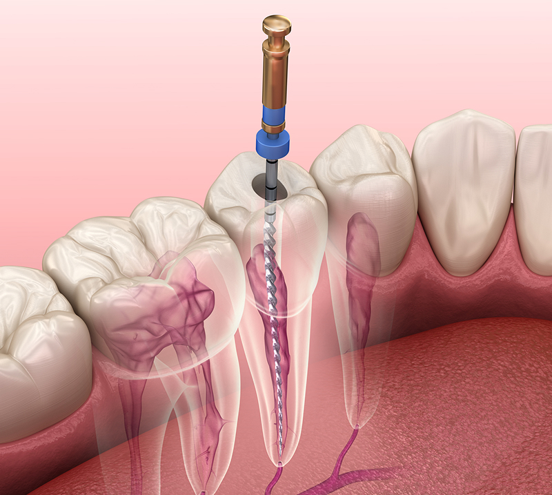 根管治療 - 千里中央の歯医者｜千里山田兄弟歯科